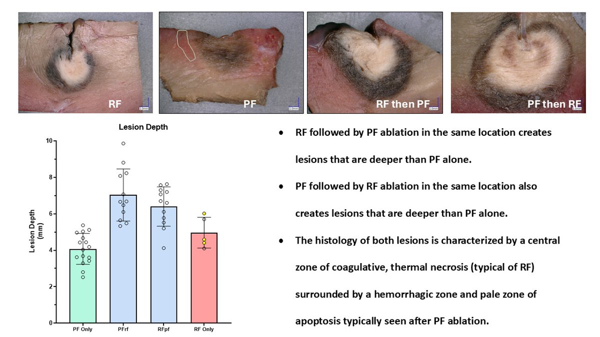 CircEP (@circulationep) on Twitter photo Combined RF and PF may increase lesion depth with a leading edge of non-thermal injury <a href="/atulverma_md/">Atul Verma</a> #AHAJournals #EPeeps
doi.org/10.1161/CIRCEP… Combined RF and PF may increase lesion depth with a leading edge of non-thermal injury <a href="/atulverma_md/">Atul Verma</a> #AHAJournals #EPeeps
doi.org/10.1161/CIRCEP…