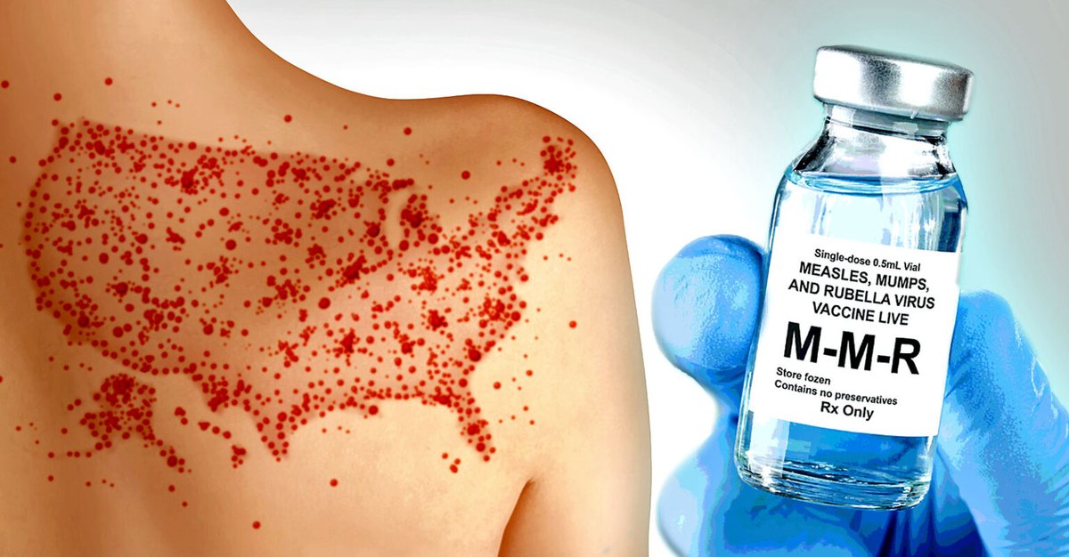 ChildrensHD's tweet image. Latest Measles Outbreaks a Result of Failed Vaccines — Not Failure to Vaccinate

As measles outbreaks continue to surface, the mainstream media is pointing the blame at HHS Secretary Robert F. Kennedy Jr.’s “anti-vaccine rhetoric.” But measles outbreaks have repeatedly occurred…