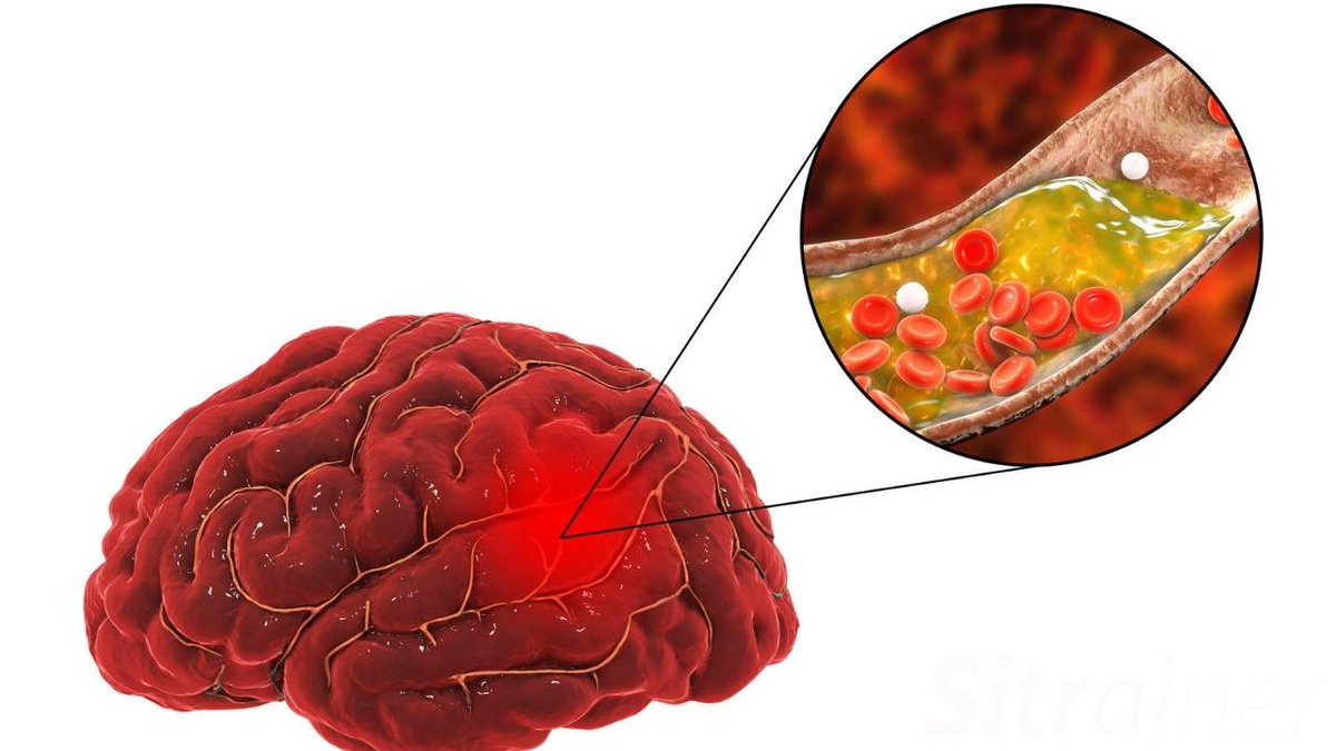 🧠 Los oxigenantes cerebrales NO existen. 

🤥 Está es una de las mentiras más grandes de la medicina.

Si realmente quieres mejorar tu “oxigenación cerebral”, debes seguir estas recomendaciones, la última, es la que más evidencia tiene.

🧵
