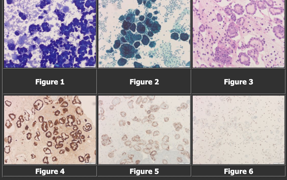 Papanicolaou Society (@papsociety) on Twitter photo Case of the month <a href="/PapSociety/">Papanicolaou Society</a>!! 73 M with a large right pleural effusion, nodular pleural thickening. What’s your diagnosis? by Drs Levani Iashvili, MD & Y. Helen Zhang.
papsociety.com/cotm25/cotmfeb…
<a href="/IACytology/">International Academy Cytology</a> <a href="/DiagnosticCyto/">Diagnostic Cytopath</a> <a href="/aakasharmand/">Zubair Baloch</a> <a href="/AzizaNassar2/">Aziza Nassar</a> #PathTwitter <a href="/helenzhang/">Helen Zhang</a> Case of the month <a href="/PapSociety/">Papanicolaou Society</a>!! 73 M with a large right pleural effusion, nodular pleural thickening. What’s your diagnosis? by Drs Levani Iashvili, MD & Y. Helen Zhang.
papsociety.com/cotm25/cotmfeb…
<a href="/IACytology/">International Academy Cytology</a> <a href="/DiagnosticCyto/">Diagnostic Cytopath</a> <a href="/aakasharmand/">Zubair Baloch</a> <a href="/AzizaNassar2/">Aziza Nassar</a> #PathTwitter <a href="/helenzhang/">Helen Zhang</a>
