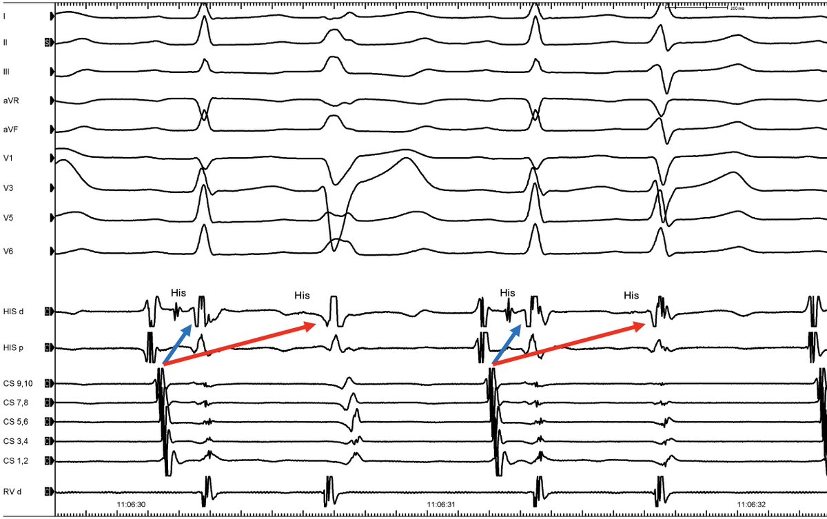 Moneeb Khalaph (@moneebkhalaph) on Twitter photo Dual atrioventricular nodal non-re-entrant tachycardia (DAVNNT)
🔥 Double Fire 🔥
1. AVN pathways: Fast & Slow
2. P is followed by 2 QRS
3. Misdiagnosed as AF or PAC
4. Therapy: Slow-Pathway modulation/ablation
<a href="/Phiso_de/">Philipp Sommer</a> <a href="/chris_sohns/">Christian Sohns</a> <a href="/melhamriti/">El Hamriti Mustapha</a> <a href="/VanessaSciacca_/">Vanessa Sciacca</a> <a href="/syamkumarmd/">Syamkumar</a> Dual atrioventricular nodal non-re-entrant tachycardia (DAVNNT)
🔥 Double Fire 🔥
1. AVN pathways: Fast & Slow
2. P is followed by 2 QRS
3. Misdiagnosed as AF or PAC
4. Therapy: Slow-Pathway modulation/ablation
<a href="/Phiso_de/">Philipp Sommer</a> <a href="/chris_sohns/">Christian Sohns</a> <a href="/melhamriti/">El Hamriti Mustapha</a> <a href="/VanessaSciacca_/">Vanessa Sciacca</a> <a href="/syamkumarmd/">Syamkumar</a>