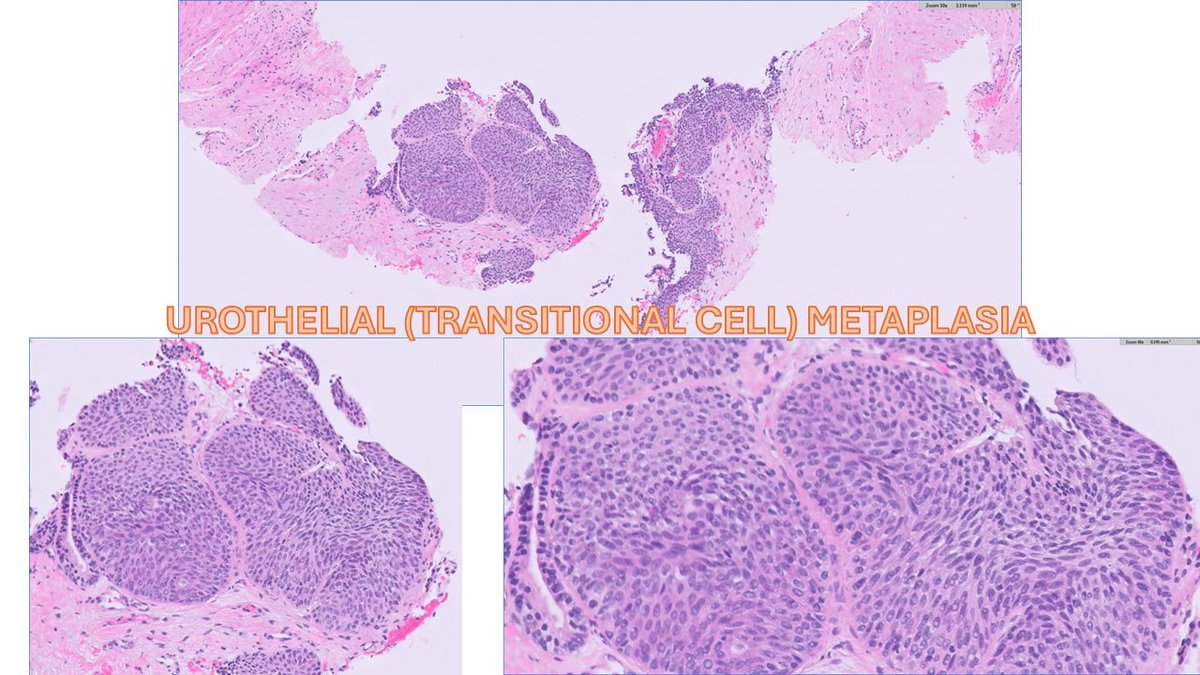 #GUpath prostate bx containing 2fer🥰#beautyinb9 mimickers of prostate cancer!

✔️POST-ATROPHIC HYERPLASIA
🔬
✔️UROTHELIAL (TRANSITIONAL CELL) METAPLASIA