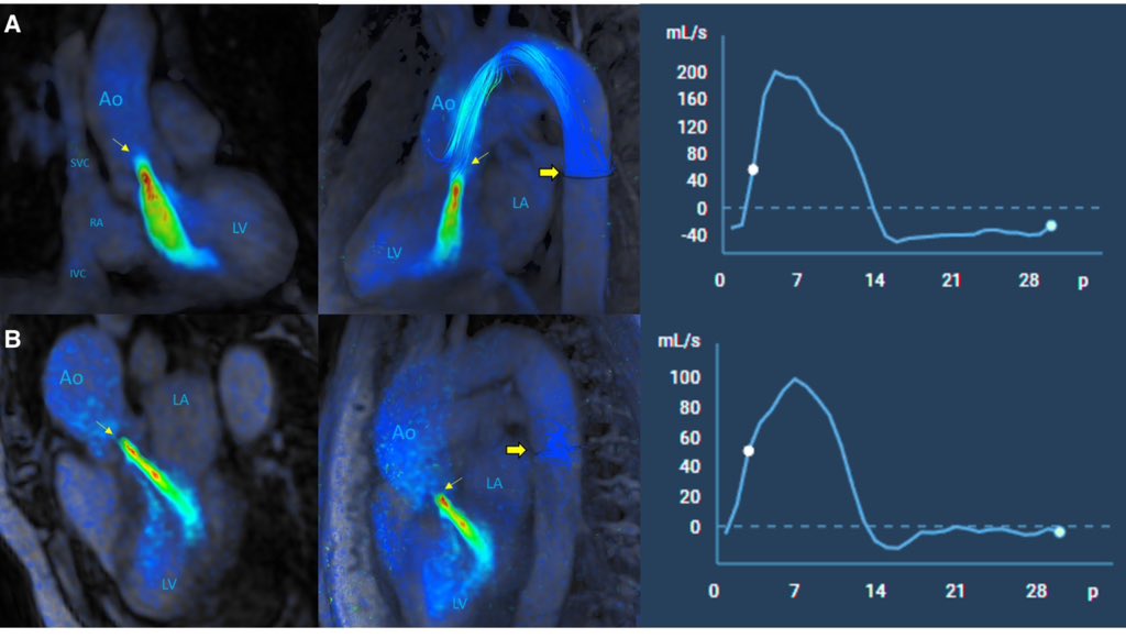 EHJ-IMP Editor-in-Chief (@ehjimpeic) on Twitter photo 'Comprehensive 4D-flow #WhyCMR evaluation of the descending thoracic aorta in AR.' by Urmeneta Ulloa et al. offers key insights—#EHJIMP ➡️ academic.oup.com/ehjimp/article… <a href="/ESC_Journals/">European Society of Cardiology Journals</a> <a href="/alessia_gimelli/">Alessia Gimelli</a> <a href="/EACVIPresident/">EACVI President</a> <a href="/EZancanaroMD/">Edoardo Zancanaro MD</a> <a href="/ShehabAnwer/">Shehab Anwer, MD</a> <a href="/s_e_petersen/">Steffen Petersen</a> 'Comprehensive 4D-flow #WhyCMR evaluation of the descending thoracic aorta in AR.' by Urmeneta Ulloa et al. offers key insights—#EHJIMP ➡️ academic.oup.com/ehjimp/article… <a href="/ESC_Journals/">European Society of Cardiology Journals</a> <a href="/alessia_gimelli/">Alessia Gimelli</a> <a href="/EACVIPresident/">EACVI President</a> <a href="/EZancanaroMD/">Edoardo Zancanaro MD</a> <a href="/ShehabAnwer/">Shehab Anwer, MD</a> <a href="/s_e_petersen/">Steffen Petersen</a>