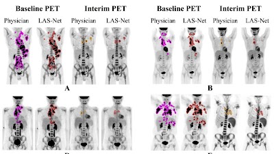 Radiology: Artificial Intelligence (@radiology_ai) on Twitter photo LAS-Net improved PET metrics across serial scans in kids with Hodgkin lymphoma doi.org/10.1148/ryai.2… <a href="/KaraKellyMD/">Kara Kelly</a> <a href="/JunjieHu12/">Junjie Hu</a> <a href="/COGorg/">Children’s Oncology Group</a> #lymphoma #OncoRad #AI LAS-Net improved PET metrics across serial scans in kids with Hodgkin lymphoma doi.org/10.1148/ryai.2… <a href="/KaraKellyMD/">Kara Kelly</a> <a href="/JunjieHu12/">Junjie Hu</a> <a href="/COGorg/">Children’s Oncology Group</a> #lymphoma #OncoRad #AI
