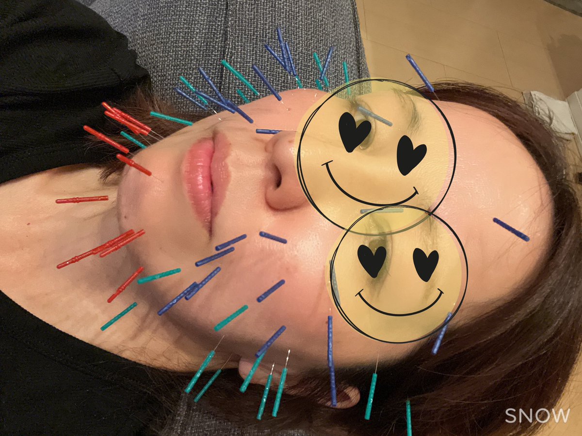 misokaree100's tweet photo. 毎週美容鍼して少し麻痺が良くなってきたかも！ https://t.co/CvMOakjYwy