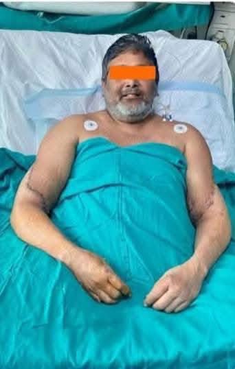 6 مارچ 2024 کو دہلی کے گنگا رام ہسپتال میں 45 سالہ پینٹر، جو 2020 میں ٹرین حادثے میں اپنے دونوں ہاتھوں سے محروم ہو گئے تھے، کا کامیاب ہاتھوں کا ٹرانسپلانٹ کیا گیا۔ انہیں مینا مہتا نامی خاتون کے عطیہ کردہ ہاتھ لگائے گئے، جو دماغی طور پر مردہ قرار دی گئی تھیں اور اپنی زندگی میں