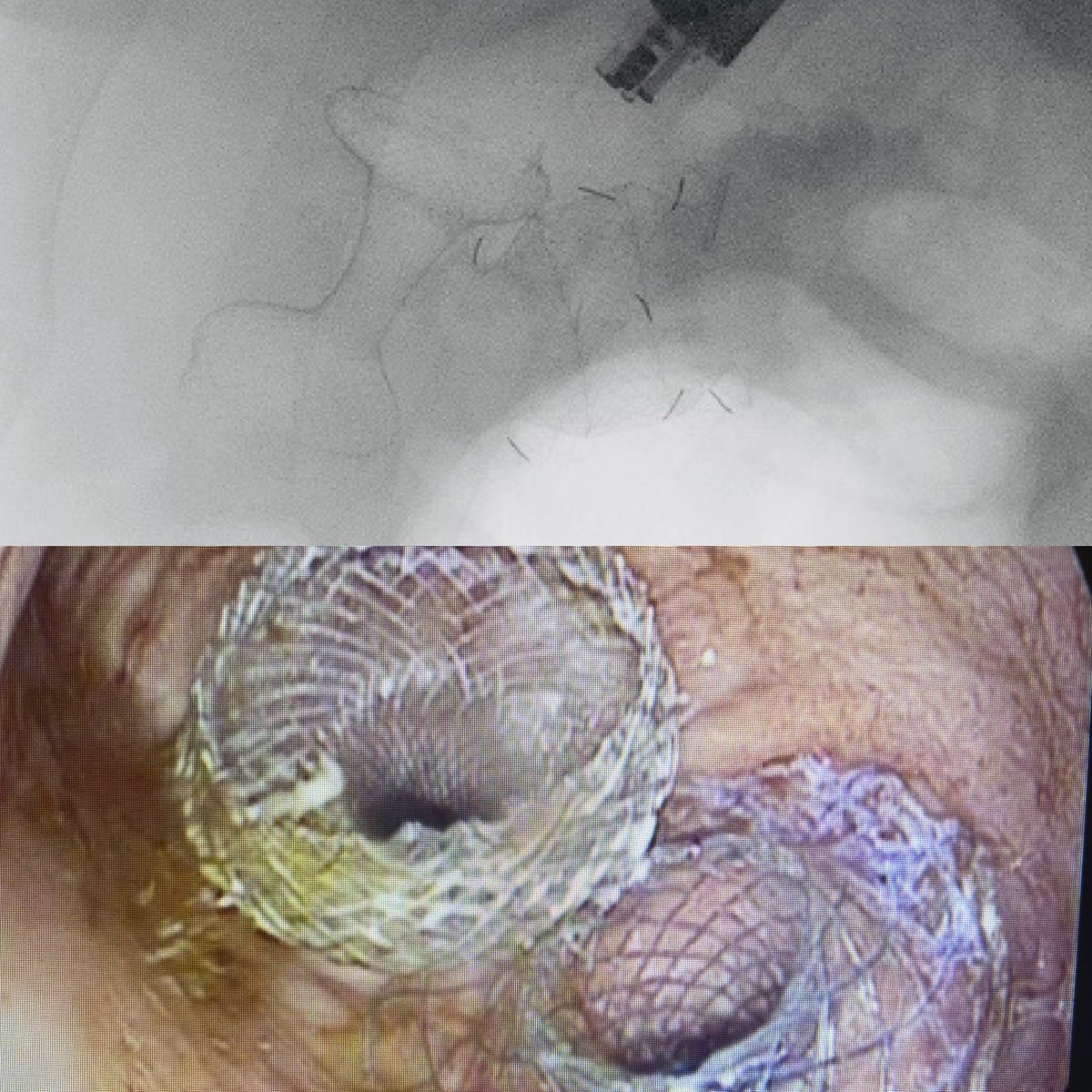 A Tale of Two Friends!

Can you guess what’s going on here? Why use two different stents (Axios vs Spaxus) beyond💰differences?

<a href="/WorldGastroOrg/">World Gastroenterology Organisation (WGO)</a> <a href="/WorldEndoOrg/">WEO</a> <a href="/ASGEendoscopy/">ASGE GI Endoscopy</a> <a href="/ESGE_news/">ESGE</a> <a href="/BritSocGastro/">BSG</a> <a href="/ScotSocGastro/">SSG</a> <a href="/WAGE_media/">WAGE</a> 

P.S. Plastic stents weren’t an option in this case!