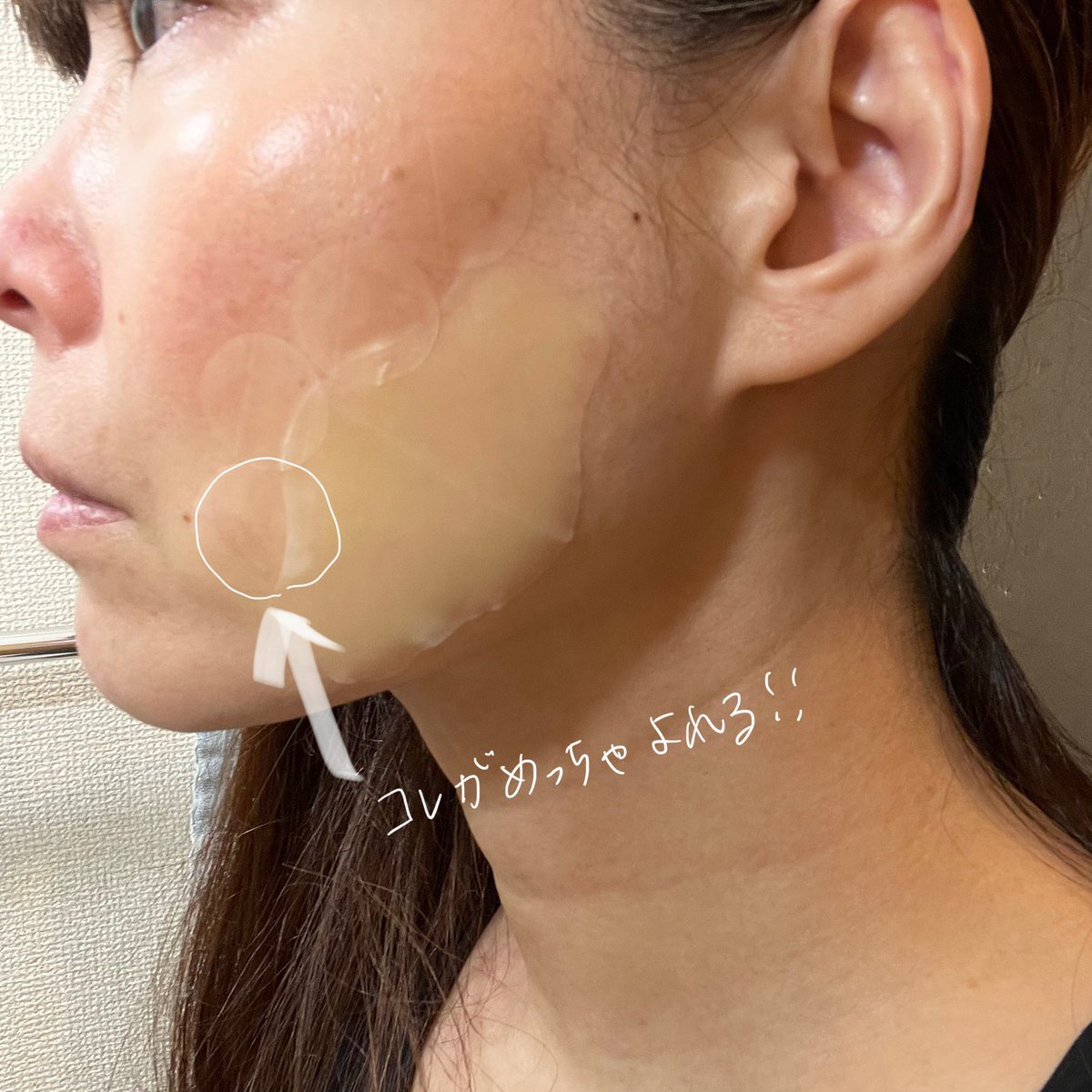 EdaMame_Shiita's tweet photo. 《2日目》
朝起きてv beamの合併症の水脹れ、赤みなど見られず。
でもこのテープ貼り方はかなり❌口元は皮膚がいろんな方向に動くから、テープを何枚も貼るのが良くない。
フルート吹くアンブシュアをしたら、皺皺婆さん👵みたい。⇨大きいテープを一枚にした。
#アトピーの毛細血管拡張症
#vbeam https://t.co/iHKkh1oxCh