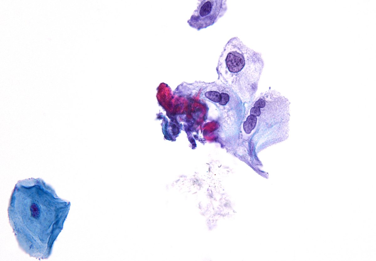 "Figure 8" bi- and trinucleation - LSIL on LBP PAP Test. (ThinPrep)