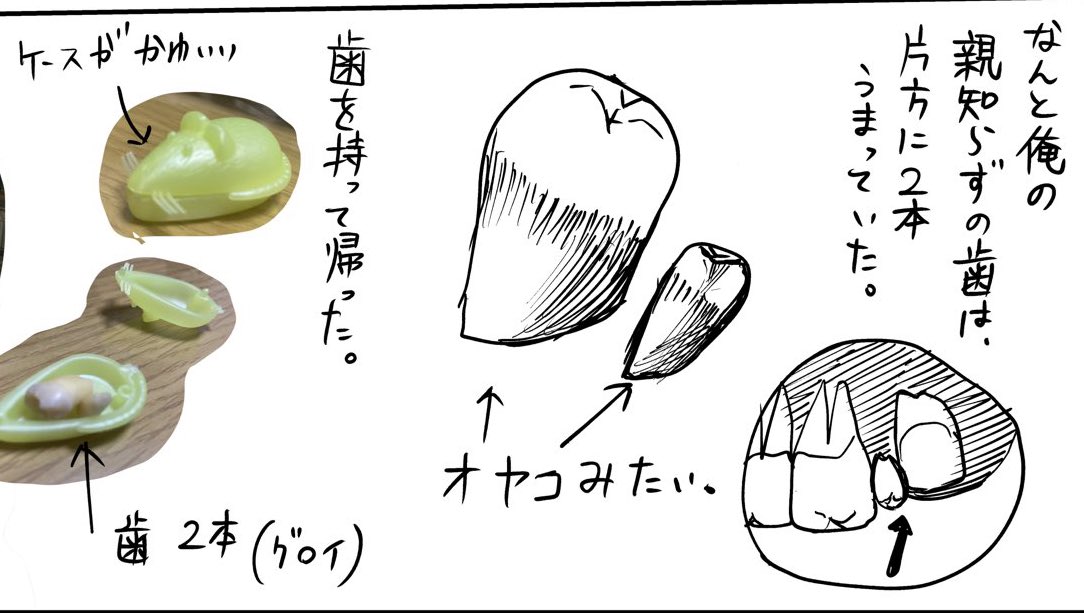 俺は親子の親知らずだったよ。 
