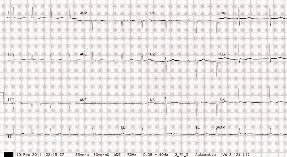 LITFL (@litflblog) on Twitter photo A puzzling case under the ICU's dim lights: A patient's heart rhythm post-mitral valve repair tests our knowledge. Is it the pacemaker or something more? litfl.com/post-op-pacing…
#CardioTwitter #FOAMed #MedEd #MedTwitter A puzzling case under the ICU's dim lights: A patient's heart rhythm post-mitral valve repair tests our knowledge. Is it the pacemaker or something more? litfl.com/post-op-pacing…
#CardioTwitter #FOAMed #MedEd #MedTwitter