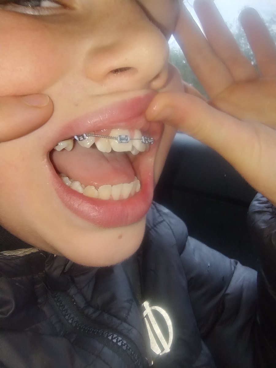 AlisonJaneOates's tweet photo. First braces for my boy https://t.co/ijAhBJy0o5
