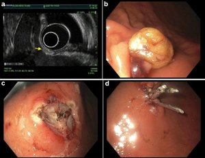 Clinical Presentation, Diagnostic Approach, and Management of Symptomatic #Gastrointestinal Lipomas
jcs.elmerpub.com/index.php/jcs/…