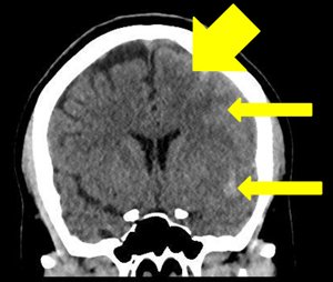 Spontaneous Subarachnoid Hemorrhage After Cesarean Section
jcgo.elmerpub.com/index.php/jcgo…
