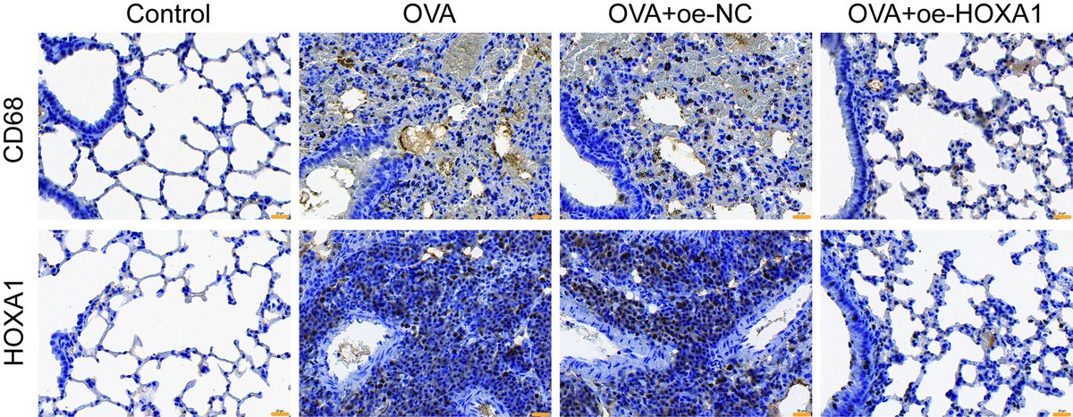 BegellMedical's tweet image. Overexpression of Homeobox A1 Relieves Ovalbumin-Induced Asthma in Mice and Is Associated with Blocking of the NF-κB Signaling Pathway

dl.begellhouse.com/journals/2ff21…

#AsthmaResearch #Immunology #InflammationControl