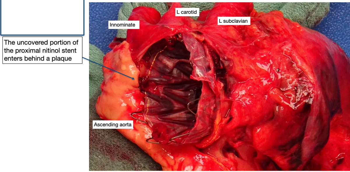 Alan Lumsden, MD, CV Chairman/Director (@alanlumsdenmd) on Twitter photo Still a role for autopsies in understanding how devices fail and in this case what caused a retrograde dissection. <a href="/ISEVSonline/">ISEVS</a> <a href="/VascularSVS/">Society for Vascular Surgery</a> <a href="/VEITHsymposium/">VEITHsymposium</a> <a href="/cxsymposium/">CX Symposium</a> <a href="/bavaremd/">Charu Bavare MD</a> <a href="/VascularSpecia4/">Vascular Specialist International</a> <a href="/VascularOnline/">Vascular Specialist Online</a> <a href="/farkomd/">frank arko</a> <a href="/vasculargirl/">Amanda riordan</a> <a href="/VesSurgery/">Journal of Vascular and Endovascular Therapy</a> <a href="/trisharoymd/">Trisha L. Roy MD PhD FACS</a> <a href="/gaescobarmd/">Guillermo Escobar🩸</a> Still a role for autopsies in understanding how devices fail and in this case what caused a retrograde dissection. <a href="/ISEVSonline/">ISEVS</a> <a href="/VascularSVS/">Society for Vascular Surgery</a> <a href="/VEITHsymposium/">VEITHsymposium</a> <a href="/cxsymposium/">CX Symposium</a> <a href="/bavaremd/">Charu Bavare MD</a> <a href="/VascularSpecia4/">Vascular Specialist International</a> <a href="/VascularOnline/">Vascular Specialist Online</a> <a href="/farkomd/">frank arko</a> <a href="/vasculargirl/">Amanda riordan</a> <a href="/VesSurgery/">Journal of Vascular and Endovascular Therapy</a> <a href="/trisharoymd/">Trisha L. Roy MD PhD FACS</a> <a href="/gaescobarmd/">Guillermo Escobar🩸</a>