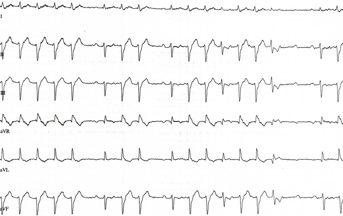 Kaspar L. (@kaspar_86) on Twitter photo What is happening here? Patient has baseline grade I AV-block, RBBB and LAFB. This is treadmill exercise ECG.
#cardiotwitter #MedTwitter #ecg
<a href="/ecgandrhythmRoe/">Dr. Andreas Roeschl</a> <a href="/DidlakeDW/">David Didlake</a> <a href="/KostekMilan/">Milan Koštek</a> <a href="/Frances98392343/">Cciari1</a> <a href="/DaveRichley/">Dave Richley</a> <a href="/Ecgloverr/">Pedram</a> What is happening here? Patient has baseline grade I AV-block, RBBB and LAFB. This is treadmill exercise ECG.
#cardiotwitter #MedTwitter #ecg
<a href="/ecgandrhythmRoe/">Dr. Andreas Roeschl</a> <a href="/DidlakeDW/">David Didlake</a> <a href="/KostekMilan/">Milan Koštek</a> <a href="/Frances98392343/">Cciari1</a> <a href="/DaveRichley/">Dave Richley</a> <a href="/Ecgloverr/">Pedram</a>