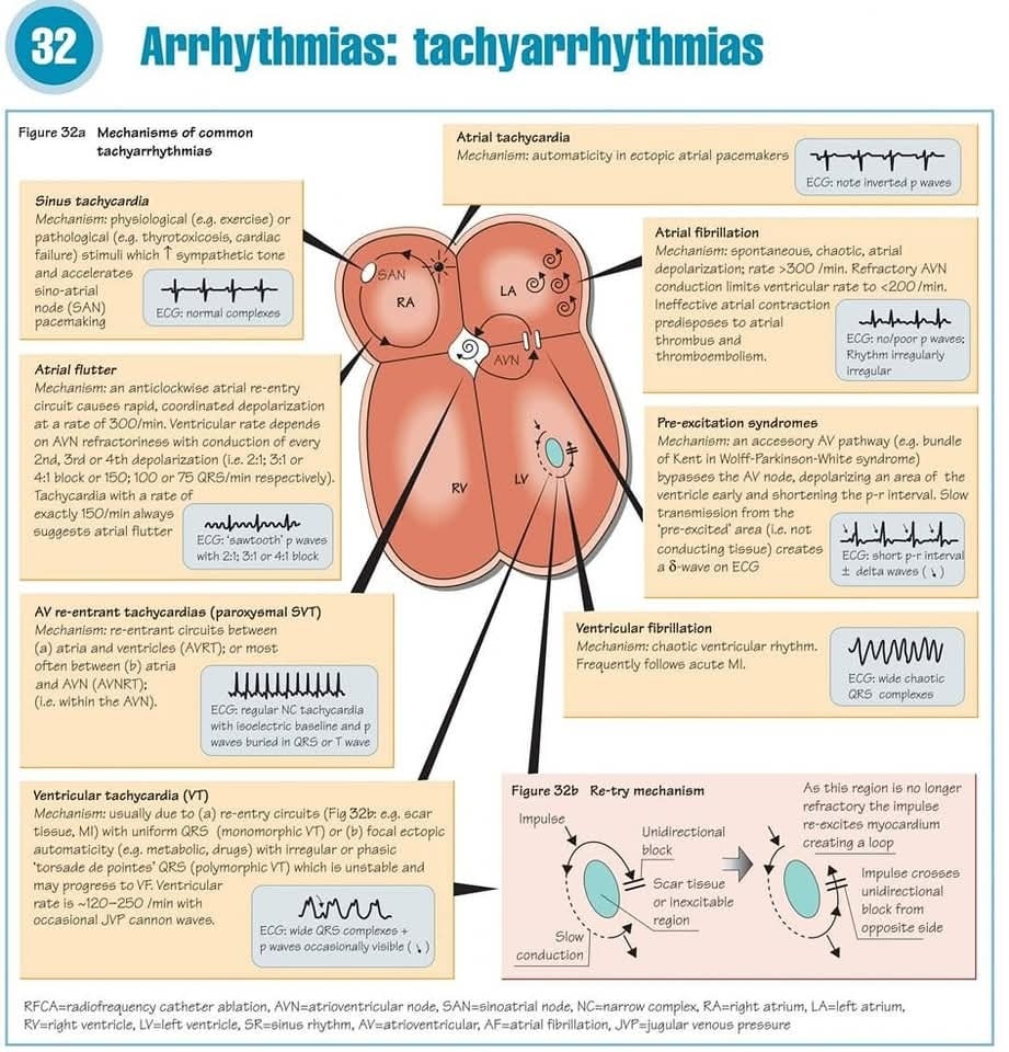 🔴Mechanisms of Common Tachyarrhythmias

AVRT arrows should probably be reversed as they describe antidromic conduction &amp; the letter δ should be capitalised (Δ) as that's why the accessory pathway wave was coined delta.

Tachyarrhythmias, Critical Care Medicine at a Glance