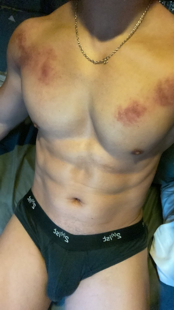 tboy_hk's tweet photo. 成日做運動/易整親必做！

平時講儲錢講扣稅
今次就講下保障層面
醫療/意外/危疾/人壽 呢啲都係要嚟保障自己資產
如果你成日做運動 有時唔覺意整親都無可避免 但睇次物理治療就起碼成千幾 仲要未必一次搞掂 

如果有份意外保 每年有萬次蚊任睇物理治療/跌打/針灸 
想知幾錢買到就搵我啦 性價比超高！ https://t.co/wjUL1RAd8y