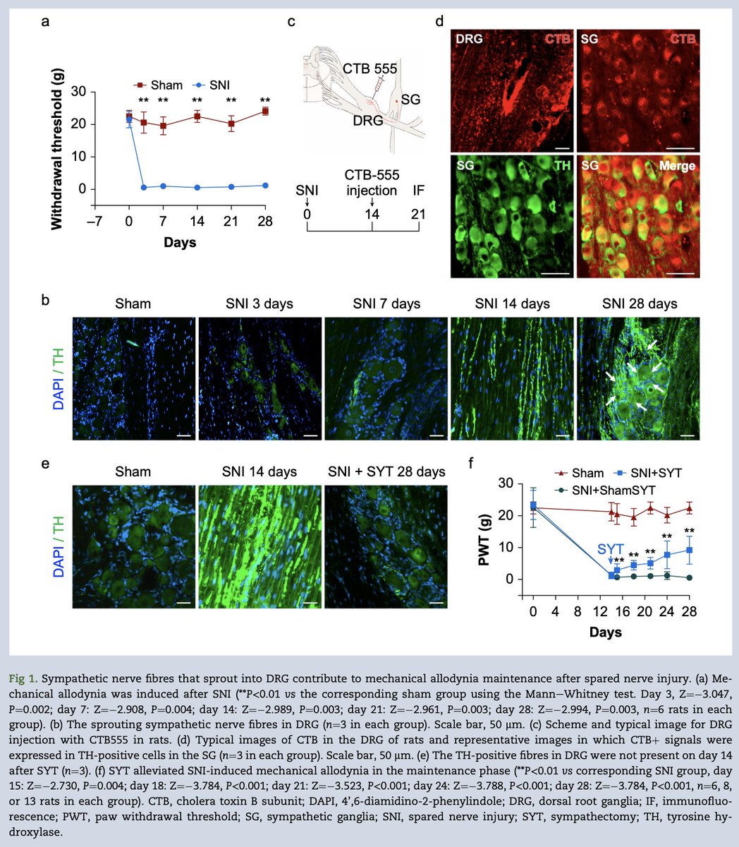 Norepinephrine and CXCL16 are co-released from the terminals of sympathetic nerve fibres in the dorsal root ganglion &amp;  synergistically contribute to the maintenance of neuropathic pain #pain #laboratory #cytokines

bjanaesthesia.org/article/S0007-…