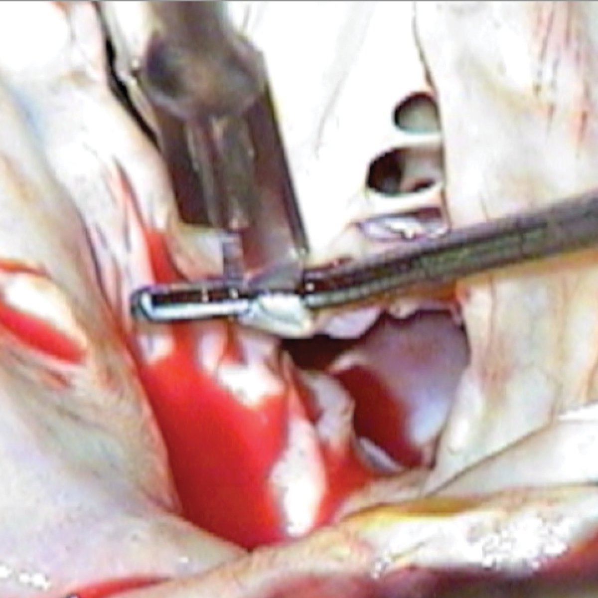 ThompsonRetract's tweet image. SURGEON TESTIMONIAL: “The Drake Hook is an important tool for subvalvular mitral repair. The cutting groove facilitates safe commissurotomy and chord lysis.” - Daniel H. Drake, MD #ThompsonRetractor