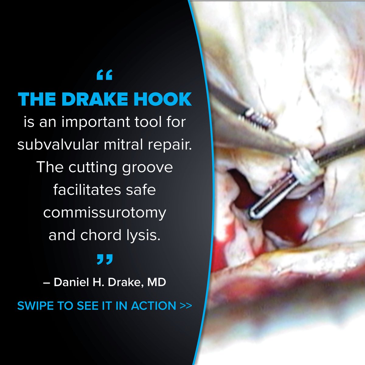 ThompsonRetract's tweet image. SURGEON TESTIMONIAL: “The Drake Hook is an important tool for subvalvular mitral repair. The cutting groove facilitates safe commissurotomy and chord lysis.” - Daniel H. Drake, MD #ThompsonRetractor
