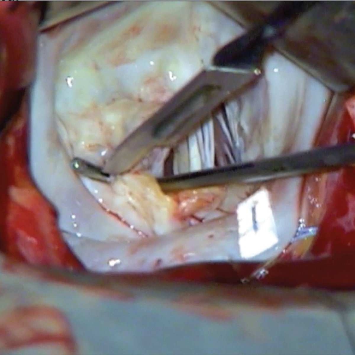 ThompsonRetract's tweet image. SURGEON TESTIMONIAL: “The Drake Hook is an important tool for subvalvular mitral repair. The cutting groove facilitates safe commissurotomy and chord lysis.” - Daniel H. Drake, MD #ThompsonRetractor