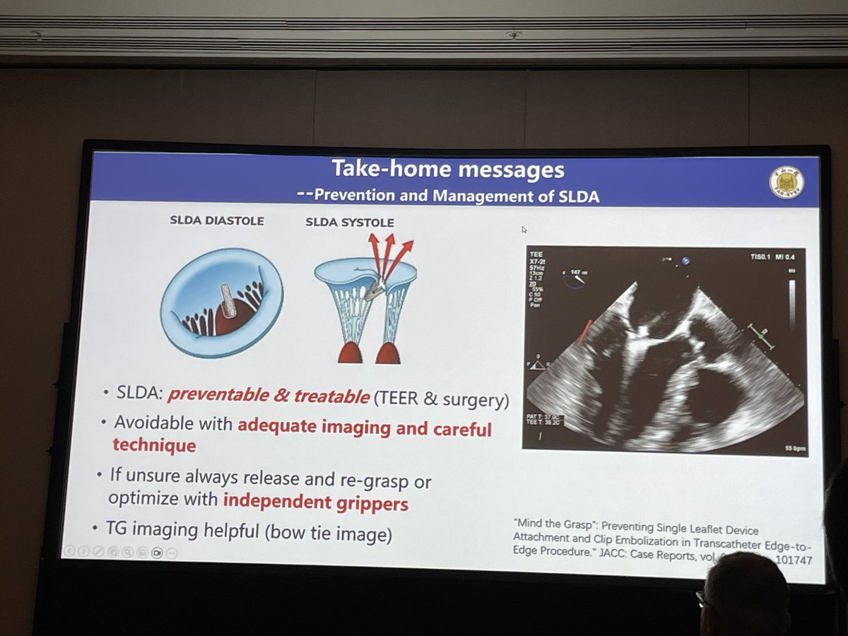 Jonathan Curio (@curiojonathan) on Twitter photo Controversies in Mitral Valve Therapy #JIMGISE2025 <a href="/jimcongress/">JIM Congress</a>
🚨SLDA as remaining challenge in M-TEER
➡️modern M-TEER needs to optimize the procedure for good long-term result
➡️risk of SLDA reduced by stabilising clip, espec when residual MR or prolaps, may need add clip Controversies in Mitral Valve Therapy #JIMGISE2025 <a href="/jimcongress/">JIM Congress</a>
🚨SLDA as remaining challenge in M-TEER
➡️modern M-TEER needs to optimize the procedure for good long-term result
➡️risk of SLDA reduced by stabilising clip, espec when residual MR or prolaps, may need add clip