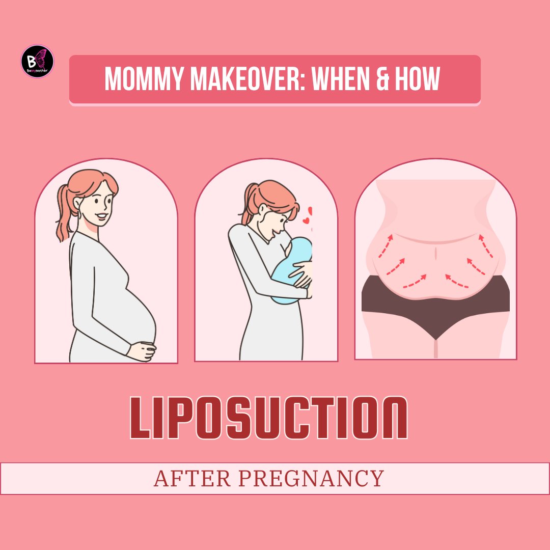 Beemymother's tweet photo. 💭 Thinking About Liposuction After Pregnancy? Here’s What You Need to Know! 🤔
https://t.co/4kr55AsxQg

#LiposuctionAfterPregnancy #PostpartumBody #MomLife #BodyAfterBaby #PregnancyRecovery #bemymother https://t.co/rkzNc6rfUF