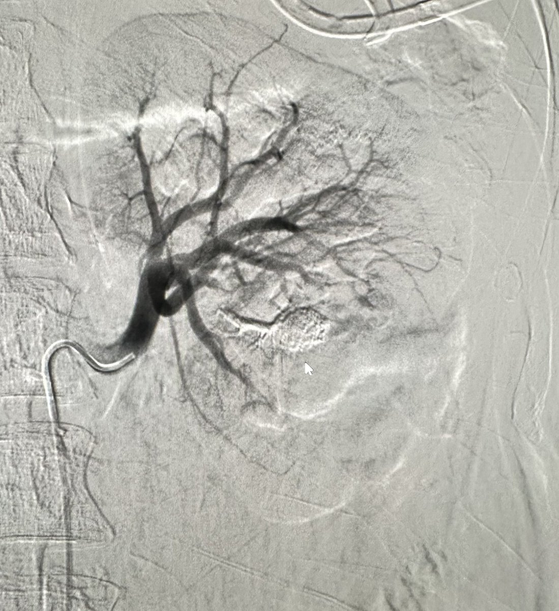 Joseph Luka MD (@jluka9) on Twitter photo Traumatic renal pseudo aneurysm/AV fistula treated with <2cc LAVA liquid embolic. No coils! <a href="/SirtexMedical/">Sirtex Medical</a> <a href="/SIRspecialists/">Society of Interventional Radiology</a> <a href="/JeffCVIR/">Jefferson Interventional Radiology</a> <a href="/JeffersonRads/">Jefferson Radiology</a> Traumatic renal pseudo aneurysm/AV fistula treated with <2cc LAVA liquid embolic. No coils! <a href="/SirtexMedical/">Sirtex Medical</a> <a href="/SIRspecialists/">Society of Interventional Radiology</a> <a href="/JeffCVIR/">Jefferson Interventional Radiology</a> <a href="/JeffersonRads/">Jefferson Radiology</a>
