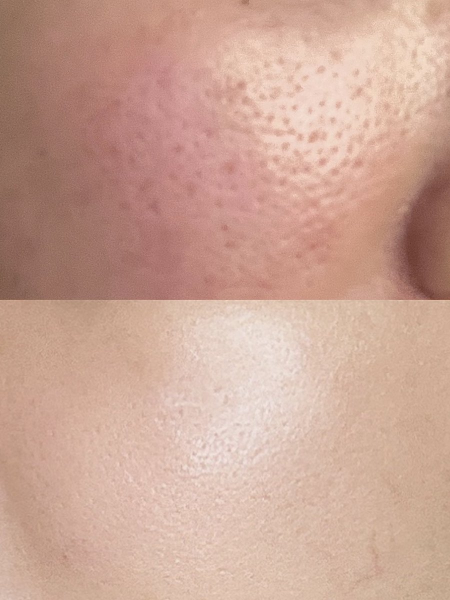 みかん肌から今の肌になるまで、
リアルに私がやってきた事をツリーに記録します。