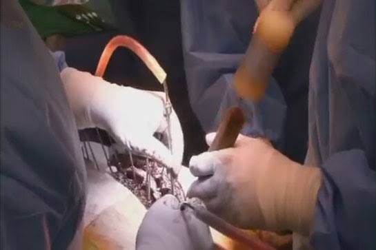 Diyarbakır Selahattin Eyyübi Devlet Hastanesi’nin Ortopedi Servisi’nde görev yapan bir doktor, ameliyat ve platin kullanımındaki artışı fark ederek hastaların röntgenlerini inceledi.

İnceleme sonucunda, en az 75 hastanın sağlam kemiklerine gereksiz platin takıldığı ve basit