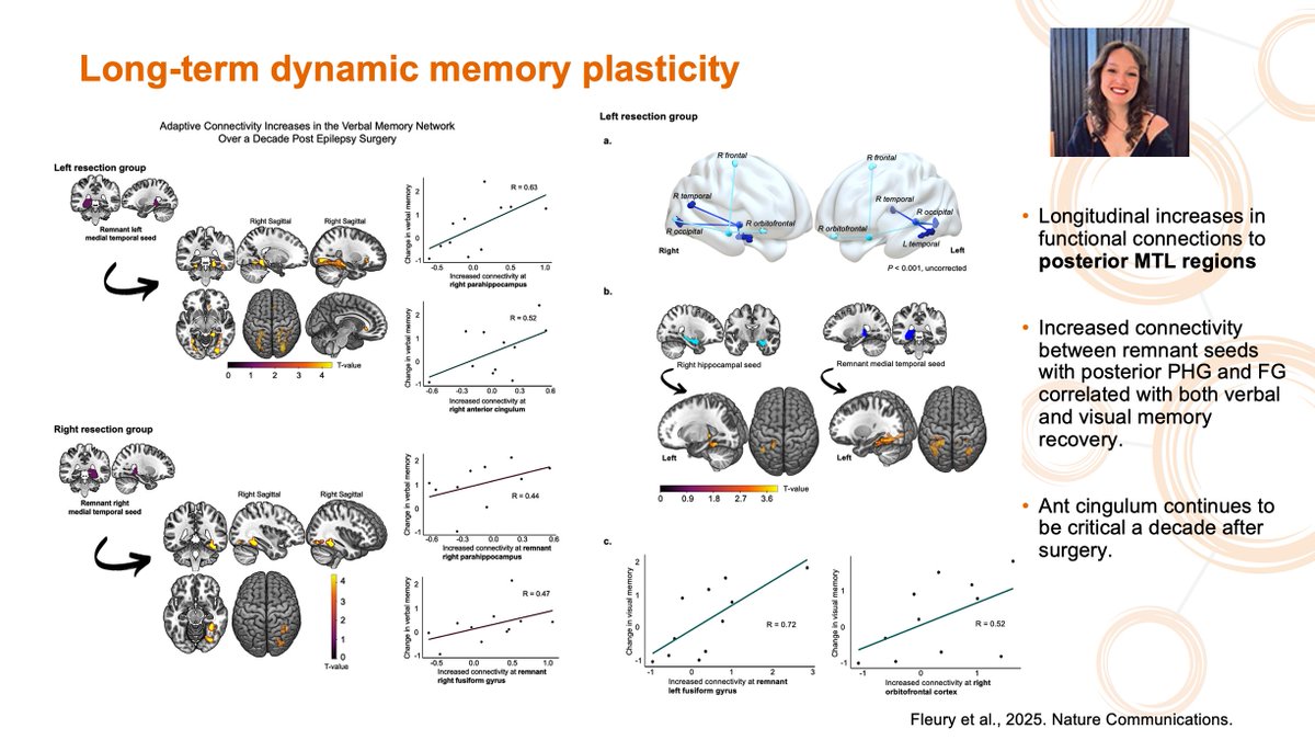 NEWepilepsy's tweet image. ✨ Highlight ✨ Epilepsy surgery triggers long-term functional and structural plasticity. Understanding these changes will help identify critical regions to preserve and reduce risks of cognitive decline. – Dr. Meneka Sidhu zoom.us/j/95048511341