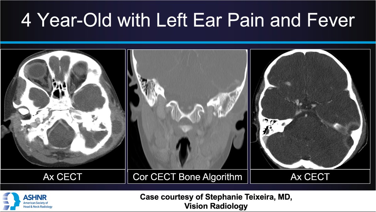 ASHNR (@ashnrsociety) on Twitter photo #ASHNRCOTW #286: Ear Pain. Thx <a href="/steixeiraMD/">Stephanie Teixeira</a> 4
case! #ASHNR25
Answer w/ appropriate GIF only -- stay professional & don't spoil it!
<a href="/callyrobs/">Caroline Robson, MBChB</a> <a href="/DShatzkes/">Deborah Shatzkes</a> <a href="/CDP_Rad/">C Douglas Phillips 🇺🇸</a> <a href="/rhwiggins/">Richard Wiggins</a>
<a href="/nakoontz/">Nicholas Koontz</a> <a href="/KRileyMD/">Kalen Riley</a> <a href="/CMGlastonbury/">Christine M Glastonbury, MD</a> <a href="/tabby_kennedy/">Tabby A. Kennedy, MD</a> <a href="/PhilipRChapman1/">Philip R. Chapman, MD</a> <a href="/cmtomblinson/">Courtney Tomblinson, MD</a> #ASHNRCOTW #286: Ear Pain. Thx <a href="/steixeiraMD/">Stephanie Teixeira</a> 4
case! #ASHNR25
Answer w/ appropriate GIF only -- stay professional & don't spoil it!
<a href="/callyrobs/">Caroline Robson, MBChB</a> <a href="/DShatzkes/">Deborah Shatzkes</a> <a href="/CDP_Rad/">C Douglas Phillips 🇺🇸</a> <a href="/rhwiggins/">Richard Wiggins</a>
<a href="/nakoontz/">Nicholas Koontz</a> <a href="/KRileyMD/">Kalen Riley</a> <a href="/CMGlastonbury/">Christine M Glastonbury, MD</a> <a href="/tabby_kennedy/">Tabby A. Kennedy, MD</a> <a href="/PhilipRChapman1/">Philip R. Chapman, MD</a> <a href="/cmtomblinson/">Courtney Tomblinson, MD</a>