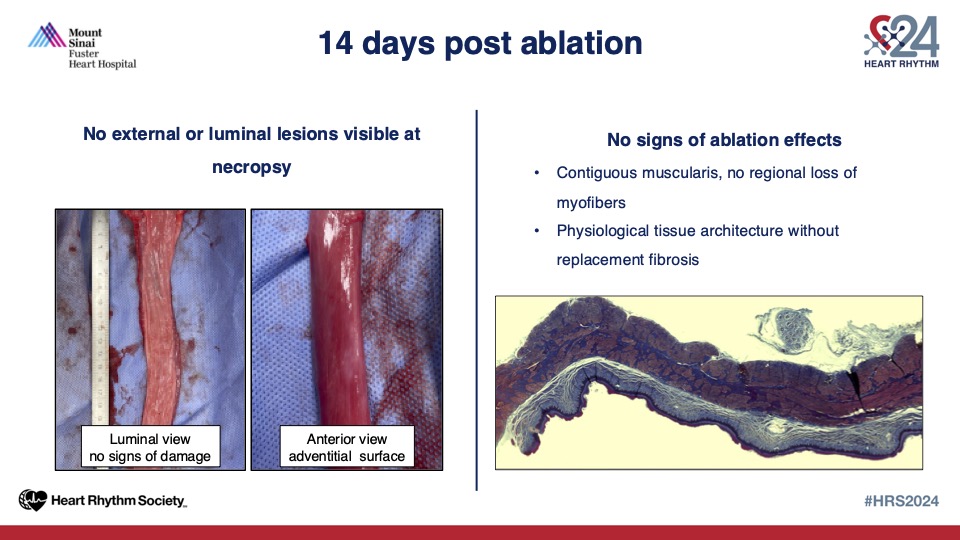 Is the esophagus truly spared after pulsed field ablation? Preclinical data suggests that PFA can induce acute esophageal lesions 
presented at #HRS2024. Such an honor to work with <a href="/jskoruth/">Jacob Koruth</a> <a href="/VivekReddyMD/">Vivek Y. Reddy</a> <a href="/DrKeitaW/">Keita Watanabe</a> !