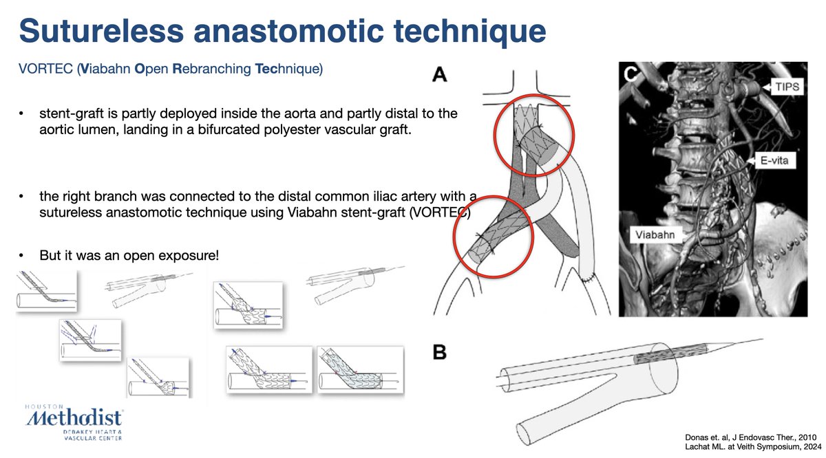 Alan Lumsden, MD, CV Chairman/Director (@alanlumsdenmd) on Twitter photo This technique lends itself to robotics -- with a few modifications a sutureless robotically delivered graft could be implanted. <a href="/ISEVSonline/">ISEVS</a> <a href="/VascularSVS/">Society for Vascular Surgery</a> <a href="/VEITHsymposium/">VEITHsymposium</a> <a href="/cxsymposium/">CX Symposium</a> <a href="/bavaremd/">Charu Bavare MD</a> <a href="/VascularSpecia4/">Vascular Specialist International</a> <a href="/VascularOnline/">Vascular Specialist Online</a> <a href="/farkomd/">frank arko</a> <a href="/vasculargirl/">Amanda riordan</a> <a href="/VesSurgery/">Journal of Vascular and Endovascular Therapy</a> <a href="/trisharoymd/">Trisha L. Roy MD PhD FACS</a> This technique lends itself to robotics -- with a few modifications a sutureless robotically delivered graft could be implanted. <a href="/ISEVSonline/">ISEVS</a> <a href="/VascularSVS/">Society for Vascular Surgery</a> <a href="/VEITHsymposium/">VEITHsymposium</a> <a href="/cxsymposium/">CX Symposium</a> <a href="/bavaremd/">Charu Bavare MD</a> <a href="/VascularSpecia4/">Vascular Specialist International</a> <a href="/VascularOnline/">Vascular Specialist Online</a> <a href="/farkomd/">frank arko</a> <a href="/vasculargirl/">Amanda riordan</a> <a href="/VesSurgery/">Journal of Vascular and Endovascular Therapy</a> <a href="/trisharoymd/">Trisha L. Roy MD PhD FACS</a>