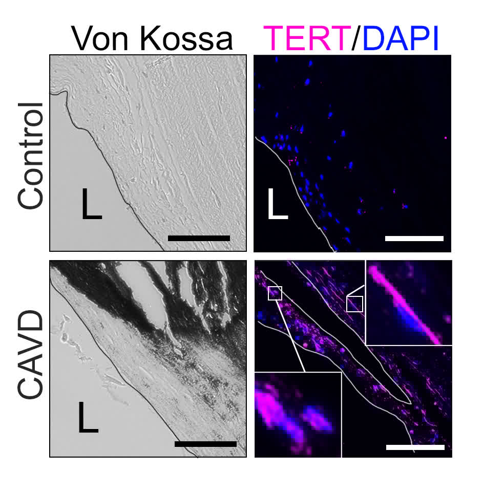 Circulation Research (@circres) on Twitter photo @Cuevas_PhD et al show TERT's non-canonical activity contributes to calcification in #CAVD. Learn more about how #TERT partners with STAT5 to activate RUNX2 revealing a potential therapeutic pathway at ahajrnls.org/4gRfqAY
<a href="/StHilaireLab/">St. Hilaire Lab</a> <a href="/RyanWong25/">Ryan Wong</a> <a href="/MarieBillaud/">Marie Billaud, PhD</a> @Cuevas_PhD et al show TERT's non-canonical activity contributes to calcification in #CAVD. Learn more about how #TERT partners with STAT5 to activate RUNX2 revealing a potential therapeutic pathway at ahajrnls.org/4gRfqAY
<a href="/StHilaireLab/">St. Hilaire Lab</a> <a href="/RyanWong25/">Ryan Wong</a> <a href="/MarieBillaud/">Marie Billaud, PhD</a>