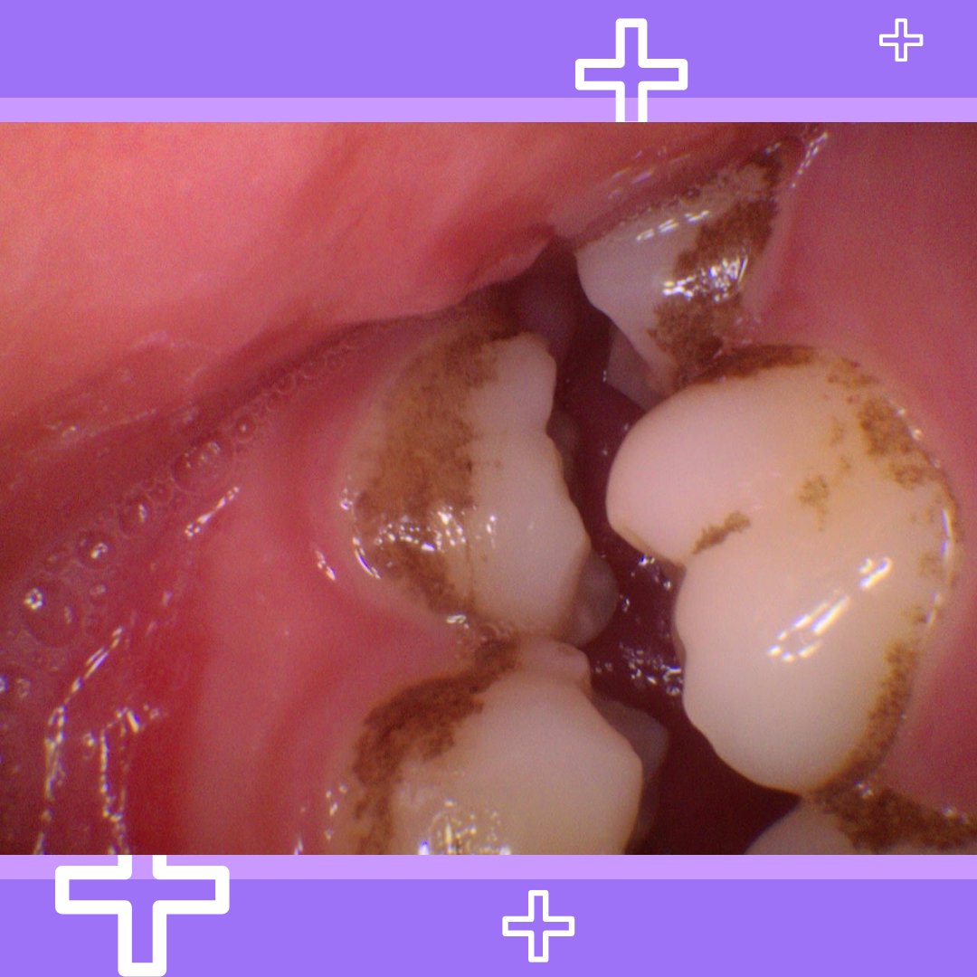 SorrisoD_'s tweet photo. Been a while since your last dental visit?
You may have built up some plaque and calculus! Call our clinic now to schedule a dental cleaning appointment!
.
#special #deal #deals #dentist #dental #cleaning #teeth #tooth #toronto #brampton #mississauga #whitening #teethcleaning https://t.co/DyfpgGBDNm