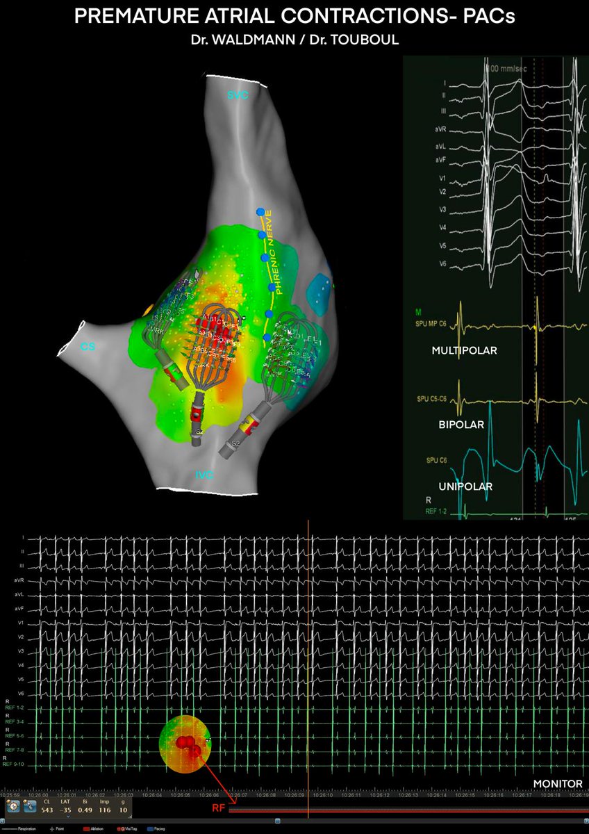 Victor Waldmann (@victor_waldmann) on Twitter photo ⚡First catheter ablation using the new Optrell multipolar mapping catheter ❤️🔥 in a pediatric patient in France today at <a href="/HopitalPompidou/">Hôpital européen Georges-Pompidou AP-HP</a> <a href="/APHP/">Assistance Publique – Hôpitaux de Paris (AP-HP)</a> <a href="/UP_Medecine/">Université Paris Cité Médecine</a>
Very good feelings and impressive signals !
<a href="/JNJMedTech/">Johnson & Johnson MedTech</a> #EPeeps ⚡First catheter ablation using the new Optrell multipolar mapping catheter ❤️🔥 in a pediatric patient in France today at <a href="/HopitalPompidou/">Hôpital européen Georges-Pompidou AP-HP</a> <a href="/APHP/">Assistance Publique – Hôpitaux de Paris (AP-HP)</a> <a href="/UP_Medecine/">Université Paris Cité Médecine</a>
Very good feelings and impressive signals !
<a href="/JNJMedTech/">Johnson & Johnson MedTech</a> #EPeeps