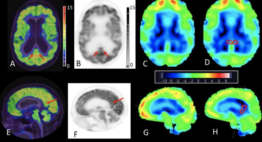 🧠 Read "Implications of Hydrocephalus on [18F]-Fluorodeoxyglucose PET Statistical Parametric Mapping Analysis in NDD Evaluation" by <a href="/AndresRicaurte1/">Andres Ricaurte Fajardo</a>, <a href="/AFrances_MDPhD/">Ana Franceschi, MD PhD</a>, <a href="/SamanthaKeilPhD/">Samantha Keil, PhD</a>, <a href="/AnnaNordvig/">Anna Nordvig MD</a>, @JOsbMD, <a href="/GloriaChiangMD/">Gloria Chiang, MD</a>, &amp; <a href="/jana_ivanidze/">Jana Ivanidze</a> in <a href="/TheAJNR/">AJNR</a> 👉tinyurl.com/2y39hn8u