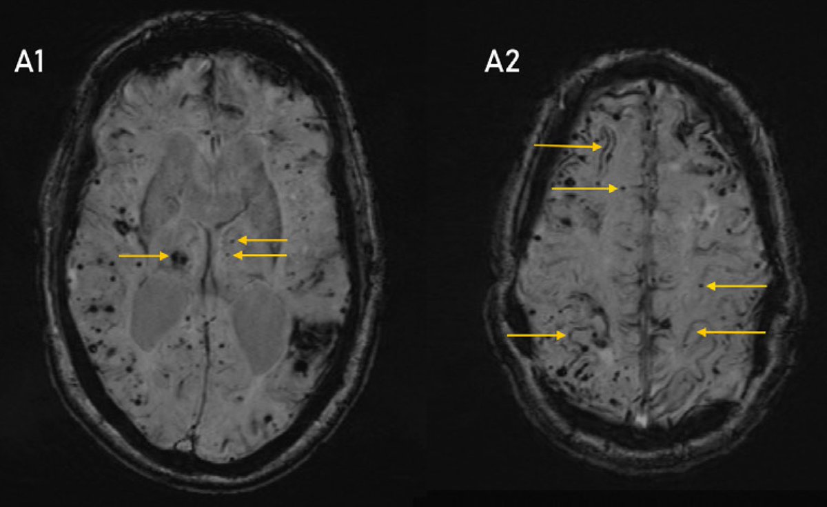 UCL Stroke Research (@uclstrokeres) on Twitter photo Check out our latest paper providing the most comprehensive description of the phenotype and natural history of iatrogenic Cerebral #Amyloid Angiopathy. A great international collaboration thanks to <a href="/SimonFaHo/">Simon Fandler-Höfler</a> <a href="/DrGargiBanerjee/">Gargi Banerjee</a> <a href="/KKaushikMD/">Kanishk Kaushik</a> <a href="/LVpanteleenko/">Larysa Panteleienko</a> and many others! Check out our latest paper providing the most comprehensive description of the phenotype and natural history of iatrogenic Cerebral #Amyloid Angiopathy. A great international collaboration thanks to <a href="/SimonFaHo/">Simon Fandler-Höfler</a> <a href="/DrGargiBanerjee/">Gargi Banerjee</a> <a href="/KKaushikMD/">Kanishk Kaushik</a> <a href="/LVpanteleenko/">Larysa Panteleienko</a> and many others!