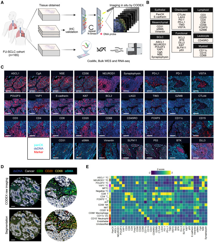 LabWaggoner's tweet photo. Integrative spatial analysis reveals tumor heterogeneity and immune colony niche related to clinical outcomes in small cell lung cancer @Cancer_Cell 
https://t.co/T7lHos1vCR https://t.co/K8ijrqEqtM