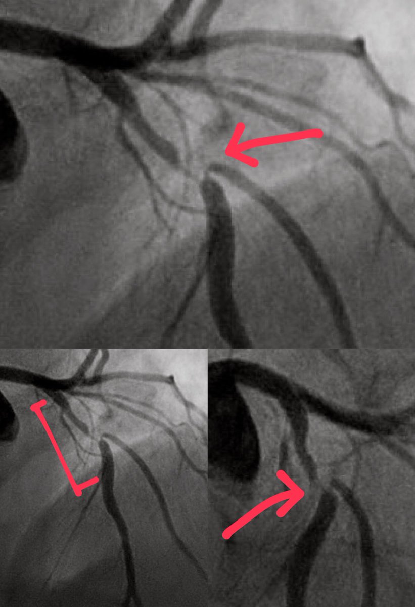 ABaliMD's tweet photo. Today’s challenging LAD/D1 bifurcation case! 🫀
Nearly hairpin turn, reverse- angle ostium of a large diagonal artery. 

Initially tried angled Supercross 120 but couldn’t make the bend.

Went ahead &amp; used #ReverseWiring technique w/ a dlMC (Sasuke) and Fielder FC https://t.co/P9WeRyj3Ws