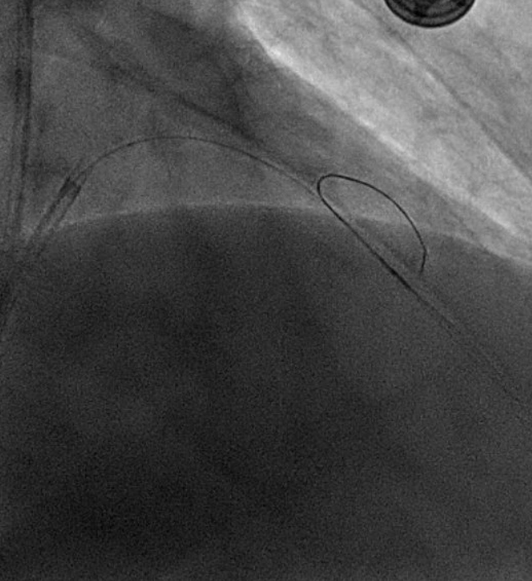 ABaliMD's tweet photo. Today’s challenging LAD/D1 bifurcation case! 🫀
Nearly hairpin turn, reverse- angle ostium of a large diagonal artery. 

Initially tried angled Supercross 120 but couldn’t make the bend.

Went ahead &amp; used #ReverseWiring technique w/ a dlMC (Sasuke) and Fielder FC https://t.co/P9WeRyj3Ws