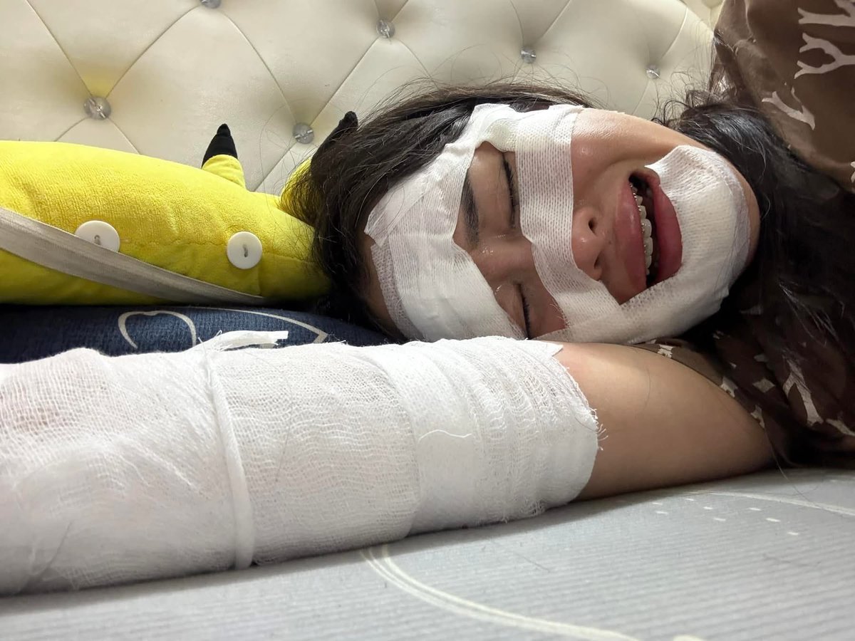 Mr_Whathapened's tweet image. เหตุเกิดที่เวียดนาม ลูกโป่งอัดแก้สไฮโดรเจนระเบิดขณะกำลังอวยพรวันเกิดเลย จำได้เมื่อหลายปีก่อนเคยมีอุบัติเหตุเกี่ยวกับลูกโป่งอัดไฮโดรเจน  ตั้งแต่นั้นมีการเปลี่ยนไปใช้ฮีเลี่ยมแล้วทำไมยังกลับมาใช้ไฮโดรเจนอีกประมาทจริงๆ