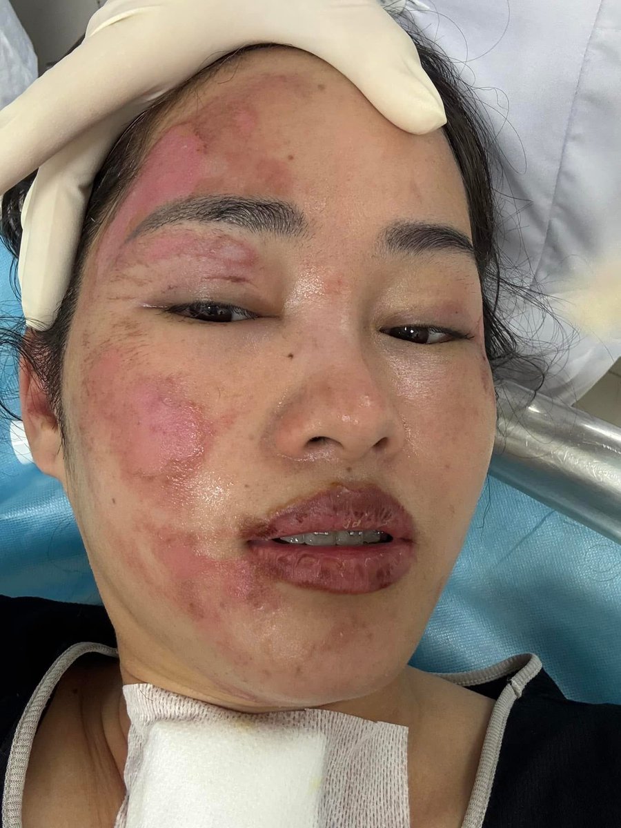 Mr_Whathapened's tweet image. เหตุเกิดที่เวียดนาม ลูกโป่งอัดแก้สไฮโดรเจนระเบิดขณะกำลังอวยพรวันเกิดเลย จำได้เมื่อหลายปีก่อนเคยมีอุบัติเหตุเกี่ยวกับลูกโป่งอัดไฮโดรเจน  ตั้งแต่นั้นมีการเปลี่ยนไปใช้ฮีเลี่ยมแล้วทำไมยังกลับมาใช้ไฮโดรเจนอีกประมาทจริงๆ