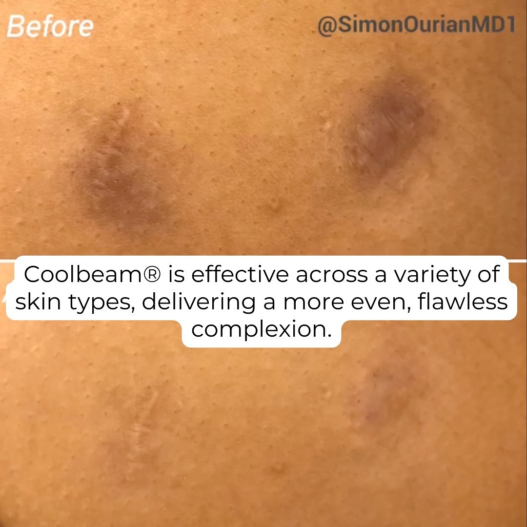 simonourianmd's tweet photo. Ready for your own transformation? Visit https://t.co/iQtAoLLEW7 for your treatment options.

#scarreduction #scars #coolbeam #coolbeamlaser https://t.co/IQEtPv1gIl