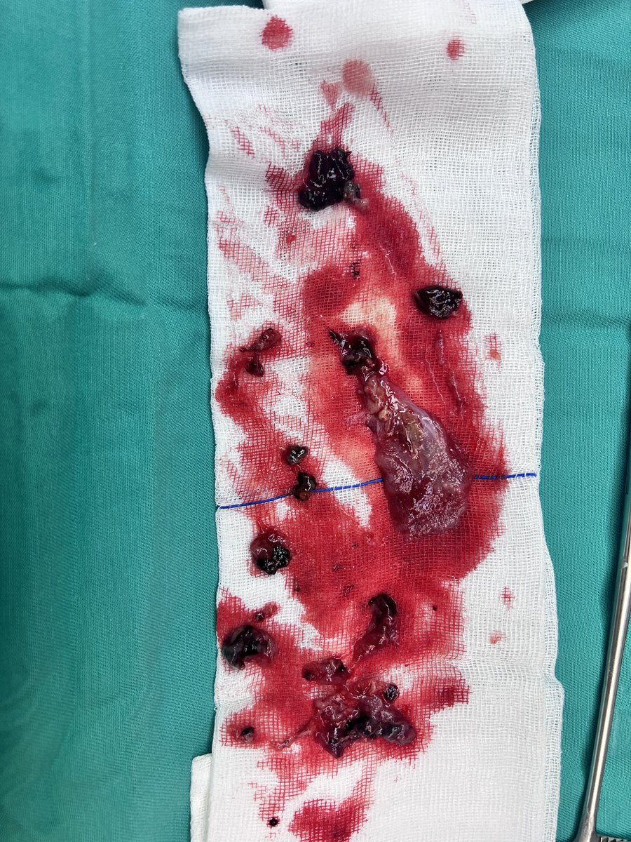 faizal_obgyn's tweet photo. Klau pesakit tanya, “doktor, klau gugur keluar janin macam mana? Sy dah 2-3x rasa ada benda turun dlm toilet”. “Oh rupanya macam telur ikan, puan. Klau jatuh dia tak boleh pecah-pecah. Klau dia pecah tu darah”. “ oooo faham doktor”
.
Lepas procedure S&C aku tunjuk la. “Ni la telur ikan tu” “ooo betul la, macam telur ikan. Patut la gugur,  mengandung anak ikan rupanya” … aku pun “krik-krik”
.
Joke a side : selalunya klau gugur bukan sbb tersalah makan nenas atau terhantuk masa naik motosikal atau stress. Selalunya janin tak sihat ( cacat ) sbb tu x dapat nk survive dalam kandungan. 😢
.
.
#missedmiscarriage #productofconception 
#ttc