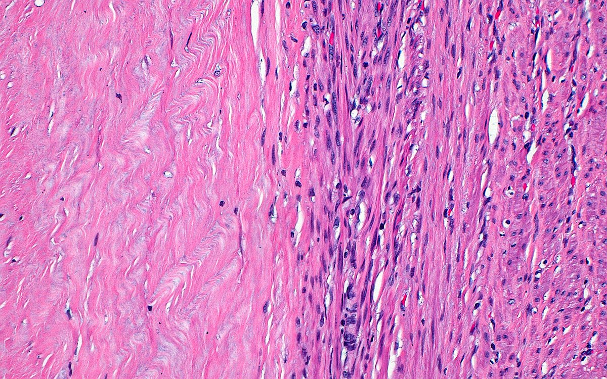 ziad_zaatari's tweet image. 🔬 Leiomyoma with Hyaline Change ~ Collagen fibers (left half of image) next to smooth muscle cells (right half) that transitioned to an area of ischemic type necrosis (outside field of image) ~ #GYNpath #Pathology #Histology