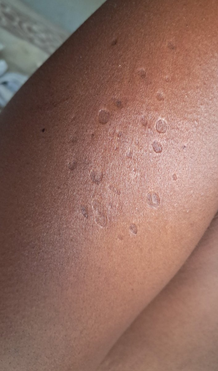 Bigmo42Nino's tweet image. Please show me a white person who have this on their shoulder.
@Anele @Abramjee @Thuso1Africa @ChrisExcel102 @CyrilRamaphosa @Rapati_Spenza @CMogoeng @SizweDhlomo @Qokani @MinnieDlamini @djsbu @EFFSouthAfrica @unclescrooch @GovernmentZA